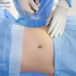 بوتاکس معده