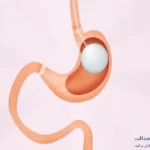 بهترین دکتر بوتاکس معده در تهران