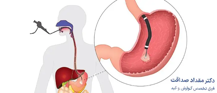 مراقبت های بعد از آندوسکوپی معده