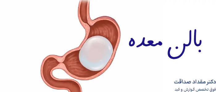 بوتاکس معده بهتر است یا بالن؟