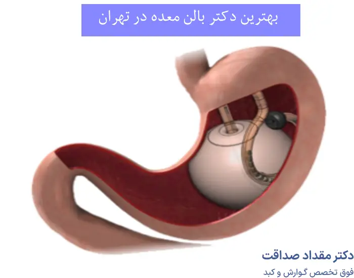 بهترین دکتر بالن معده در تهران