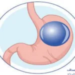 بهترین دکتر بالن معده در تهران