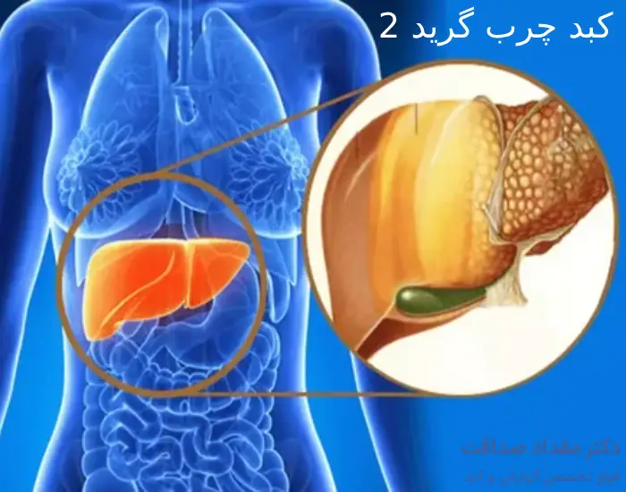 کبد چرب گرید 2؛ راهنمای جامع