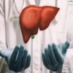 کبد چرب گرید 2