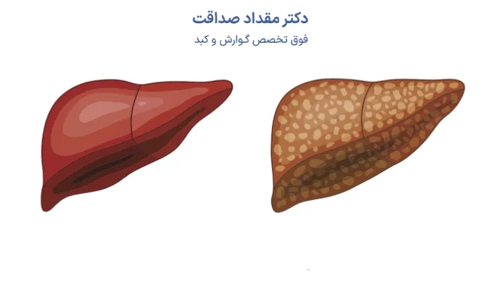 کبد چرب؛ انواع آن + علائم و نحوه تشخیص بیماری