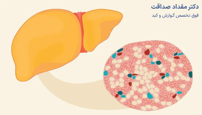 کبد چرب؛ انواع آن + علائم و نحوه تشخیص بیماری