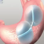 رژیم غذایی بعد از بالن معده