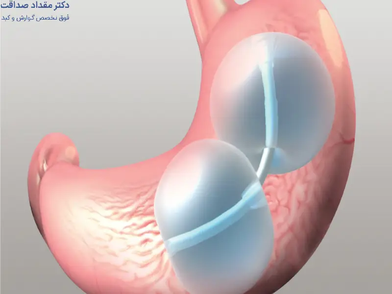 رژیم غذایی بعد از بالن معده