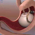 عوارض بالن معده