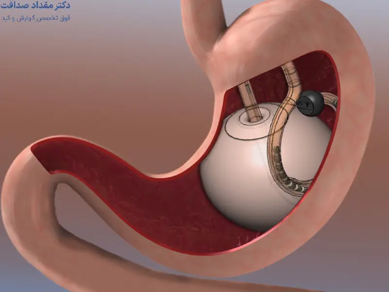 عوارض بالن معده