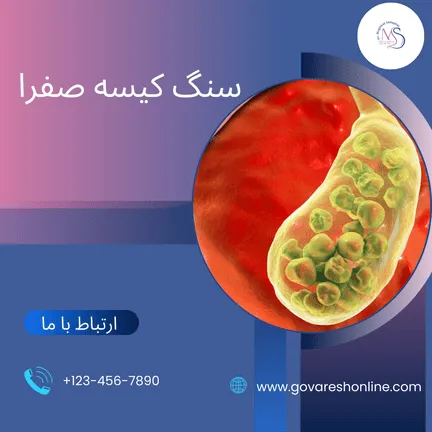 سنگ کیسه صفرا؛ علت و علائم