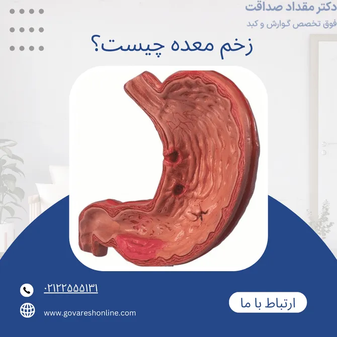 زخم معده؛ علائم، علت و روش های پیشگیری