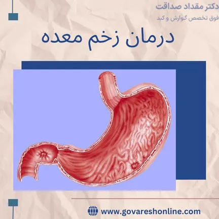 درمان زخم معده چگونه است؟