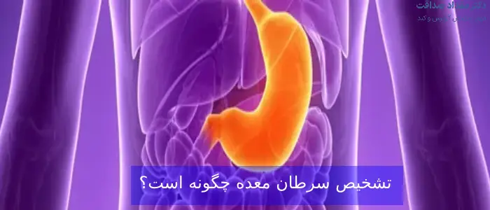 سرطان معده و همه چیز درباره آن