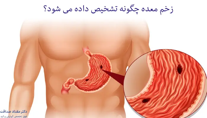 زخم معده؛ علائم، علت و روش های پیشگیری