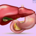 سنگ کیسه صفرا