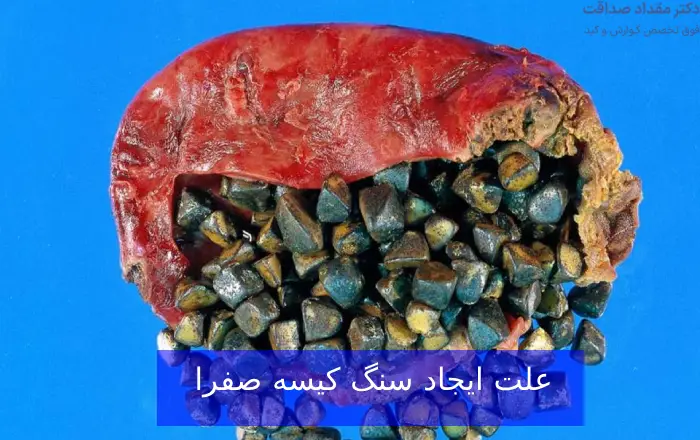 سنگ کیسه صفرا؛ علت و علائم