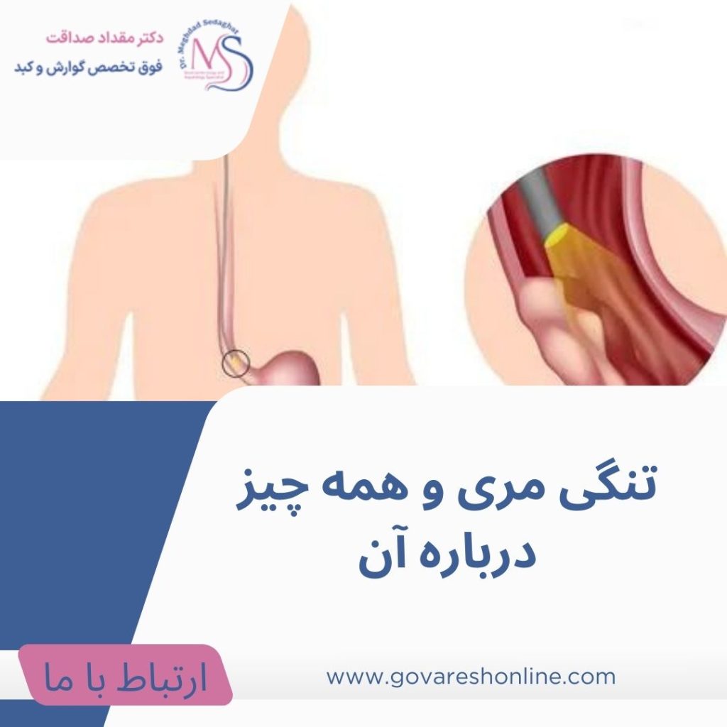 تنگی مری؛ علائم + تشخیص و پیشگیری