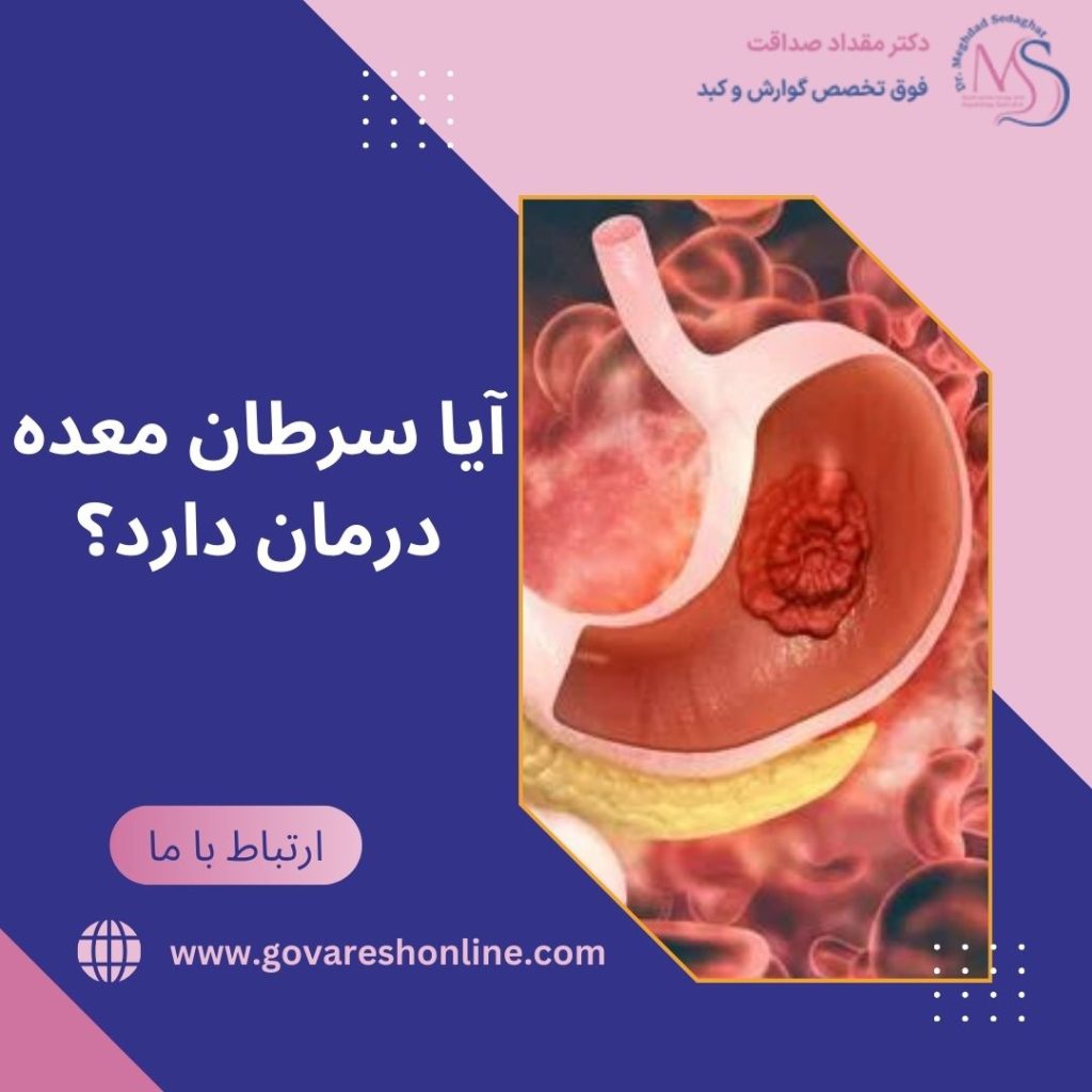 درمان سرطان معده؛ چگونگی درمان و انواع روش‌ها