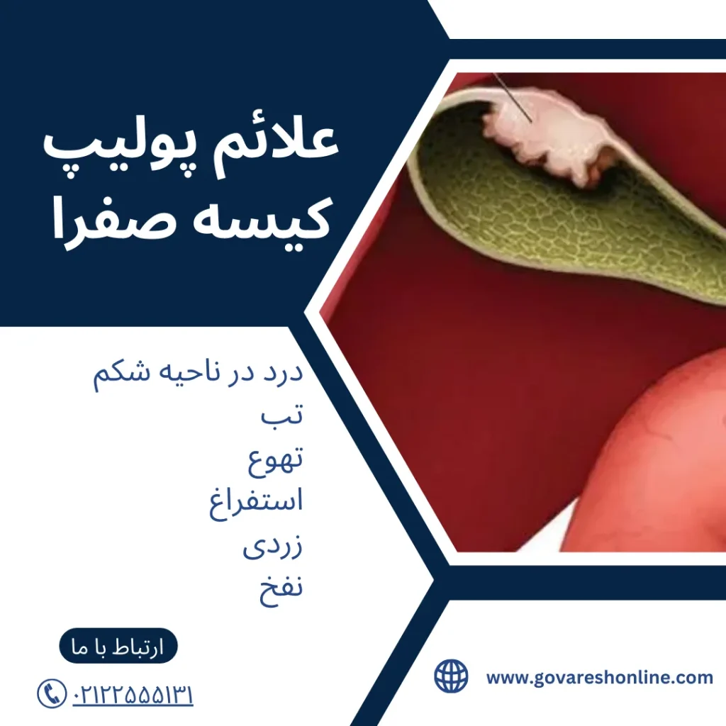پولیپ کیسه صفرا و همه چیز درباره آن
