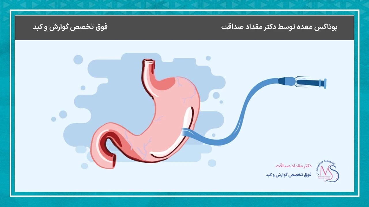 بوتاکس معده و تأثیر آن بر کاهش اشتها – آیا واقعاً مؤثر است؟