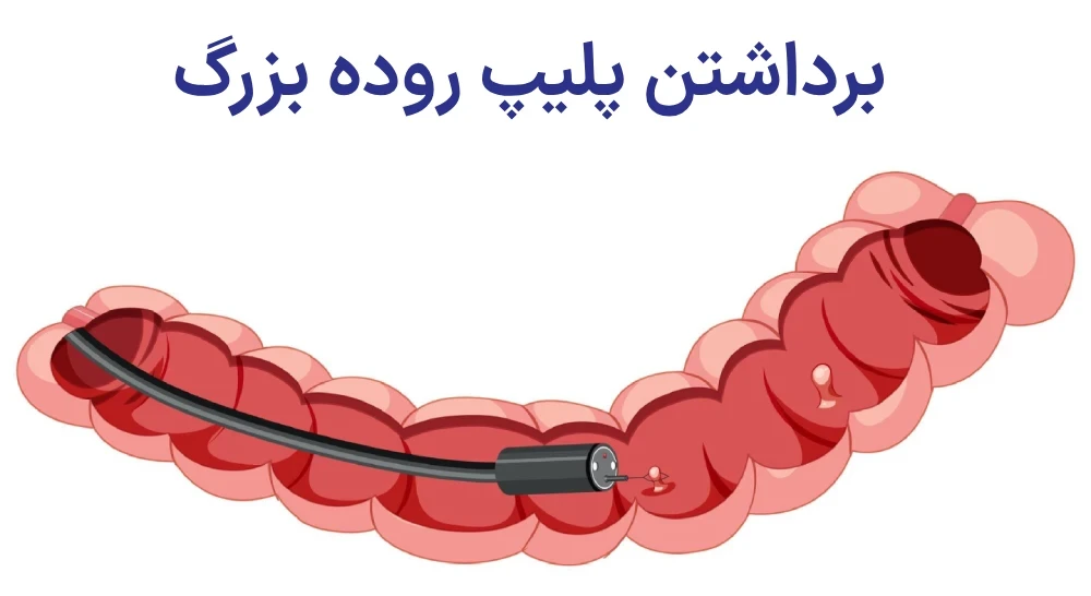 پولیپ‌ روده بزرگ چیست؟
