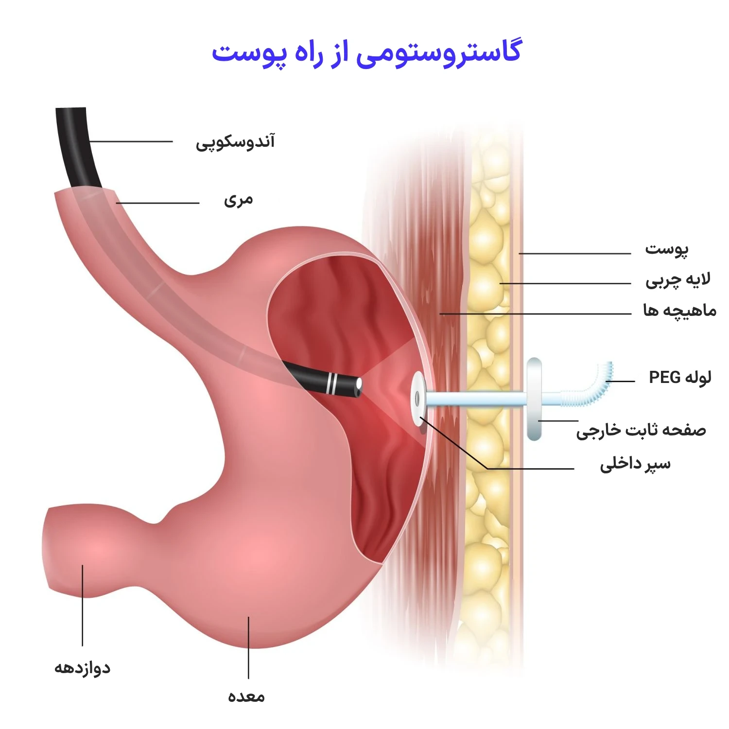 گاستروستومی