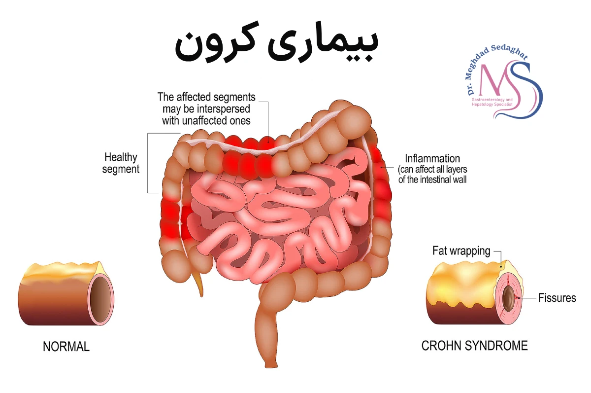 بیماری کرون و همه چیز درباره آن