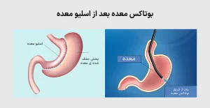 بوتاکس معده