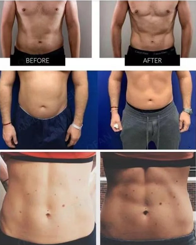 لاغری و عضله‌ سازی با دستگاه EMS