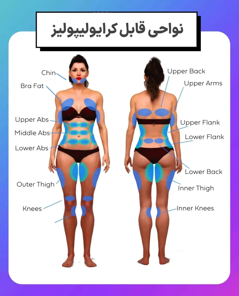 فریز کردن چربی یا کرایولیپولیز چیست؟