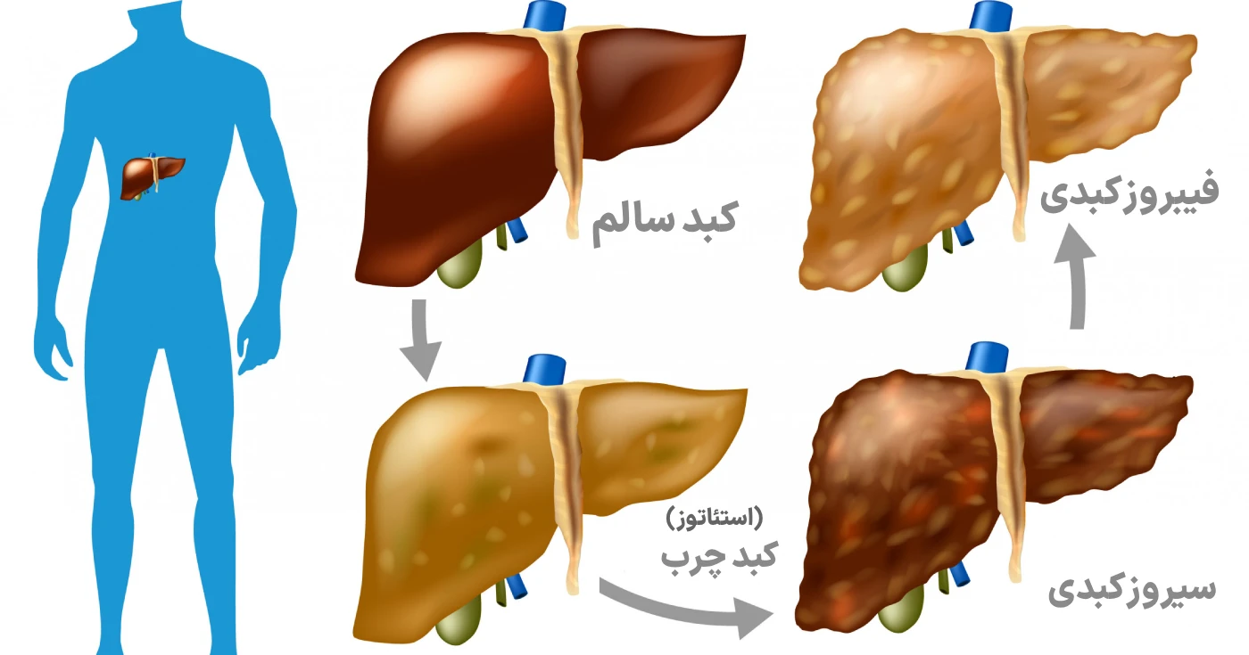 بیماری های کبدی