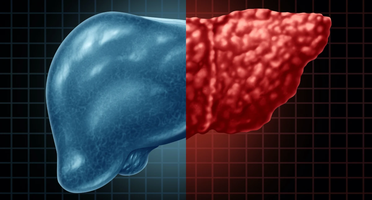 بیماری های کبدی