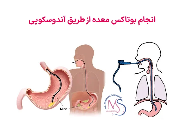 بوتاکس معده چیست؟