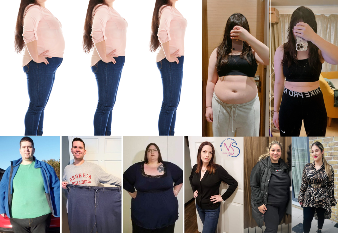 بوتاکس معده چیست؟